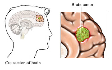 Brain India, Tumors India, Brain Problems India, Brain Tumor Cure India, New Brain Tumor Treatments India